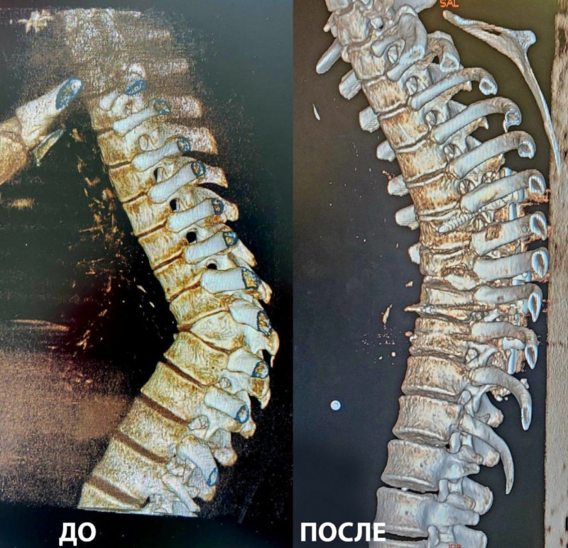 Самарские врачи провели подростку сложную операцию с врожденной кифотической деформацией позвоночника